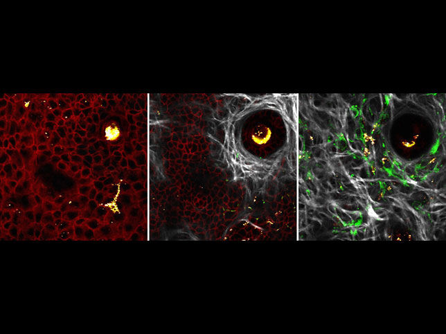 Layers of a melanoma. Microneedle-delivered tamoxifen induces a malignant melanoma in a genetically engineered mouse. Different depths of skin are shown with the invasive phenotype of melanoma cells being demonstrated. Red - normal cells; green - tumor cells; white - collagen. By Lauren Adelaar/Michael Zhang/Greg Szeto, Jeffrey Wyckoff